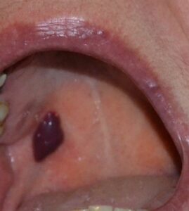 Perforation of the inner part of the victim's throat